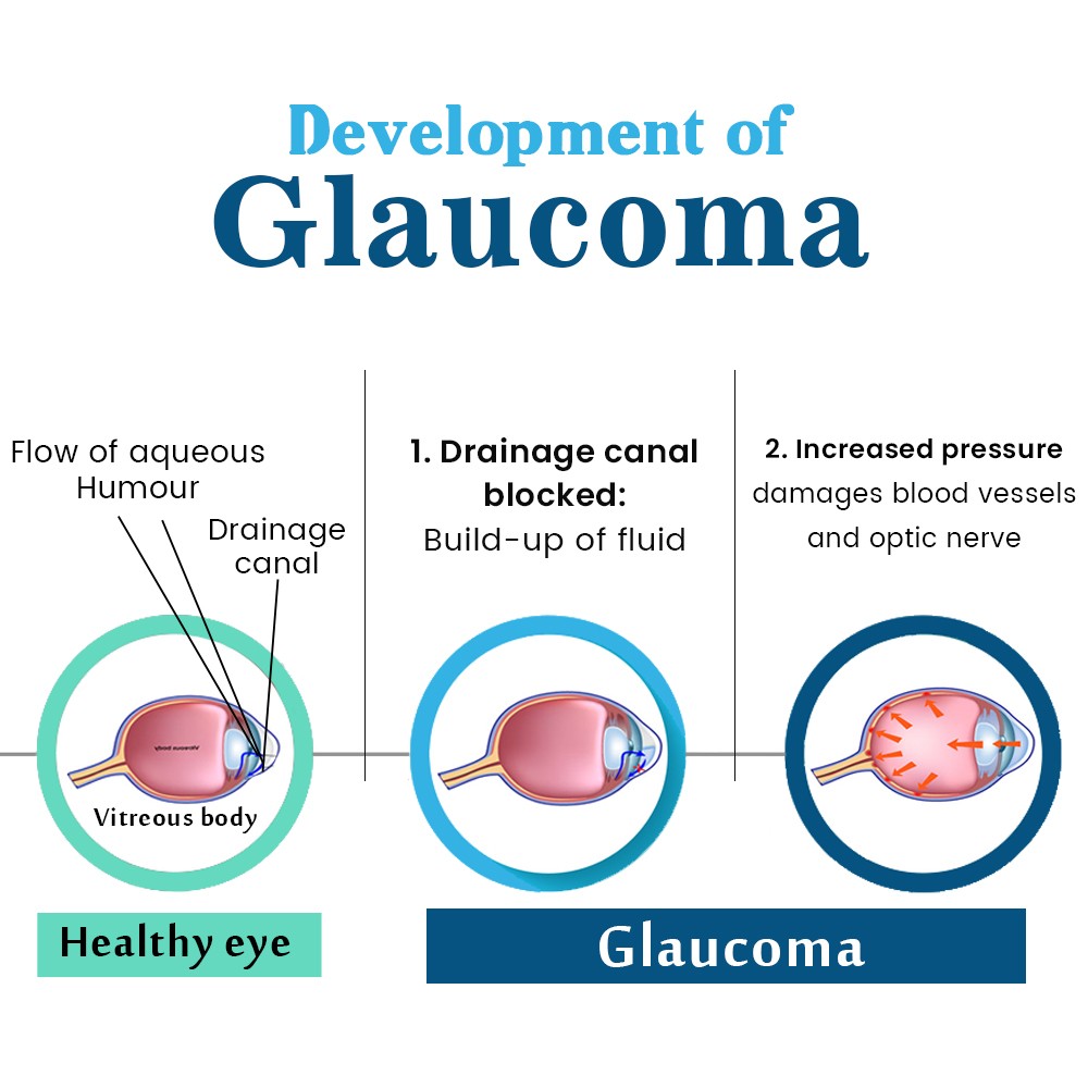 Development of Glaucoma