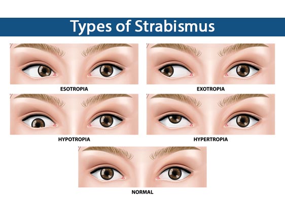 What are the types of strabismus
