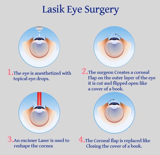 Lasik Surgery New